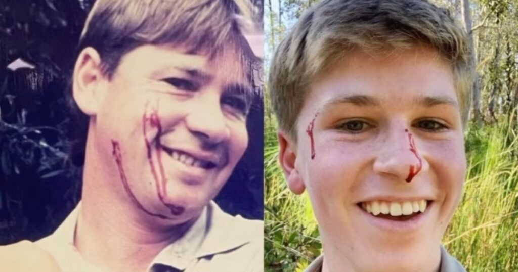 Robert Irwin Bitten in the Face by Same Kind of Snake as Late Father Steve